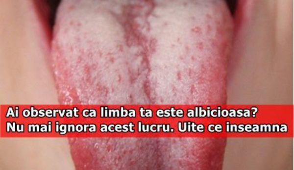 limba ta este albicioasă
