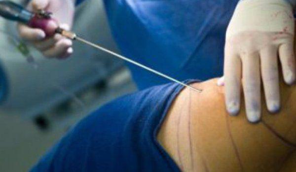 liposuctie facuta in Italia