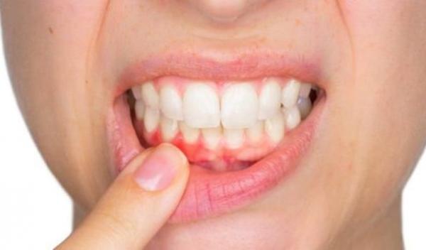 abces-dentar
