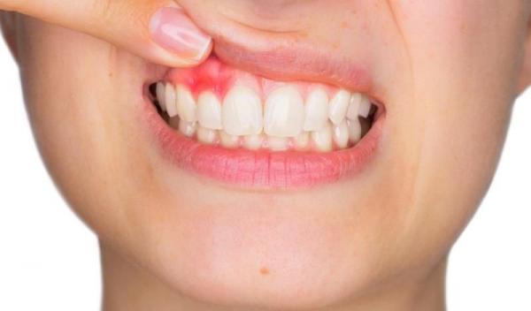 sangerarile-gingivale