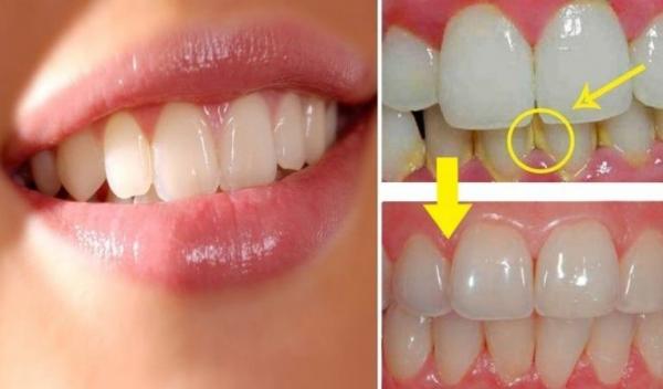 cum-sa-elimini-placa-dentara