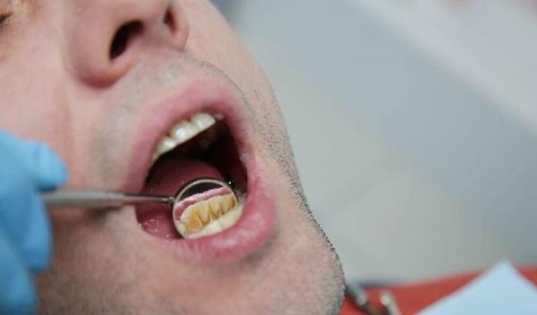 tartrul dentar