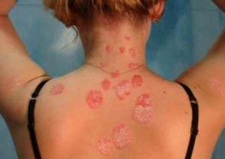psoriazis