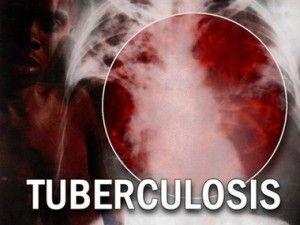 tuberculoza
