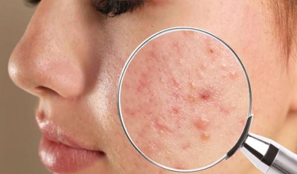 acnee-cauze-tratament