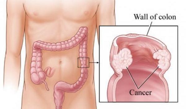 cancer_colon