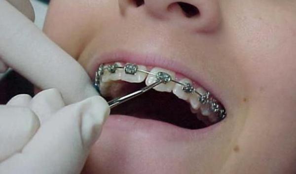 Aparatul-dentar